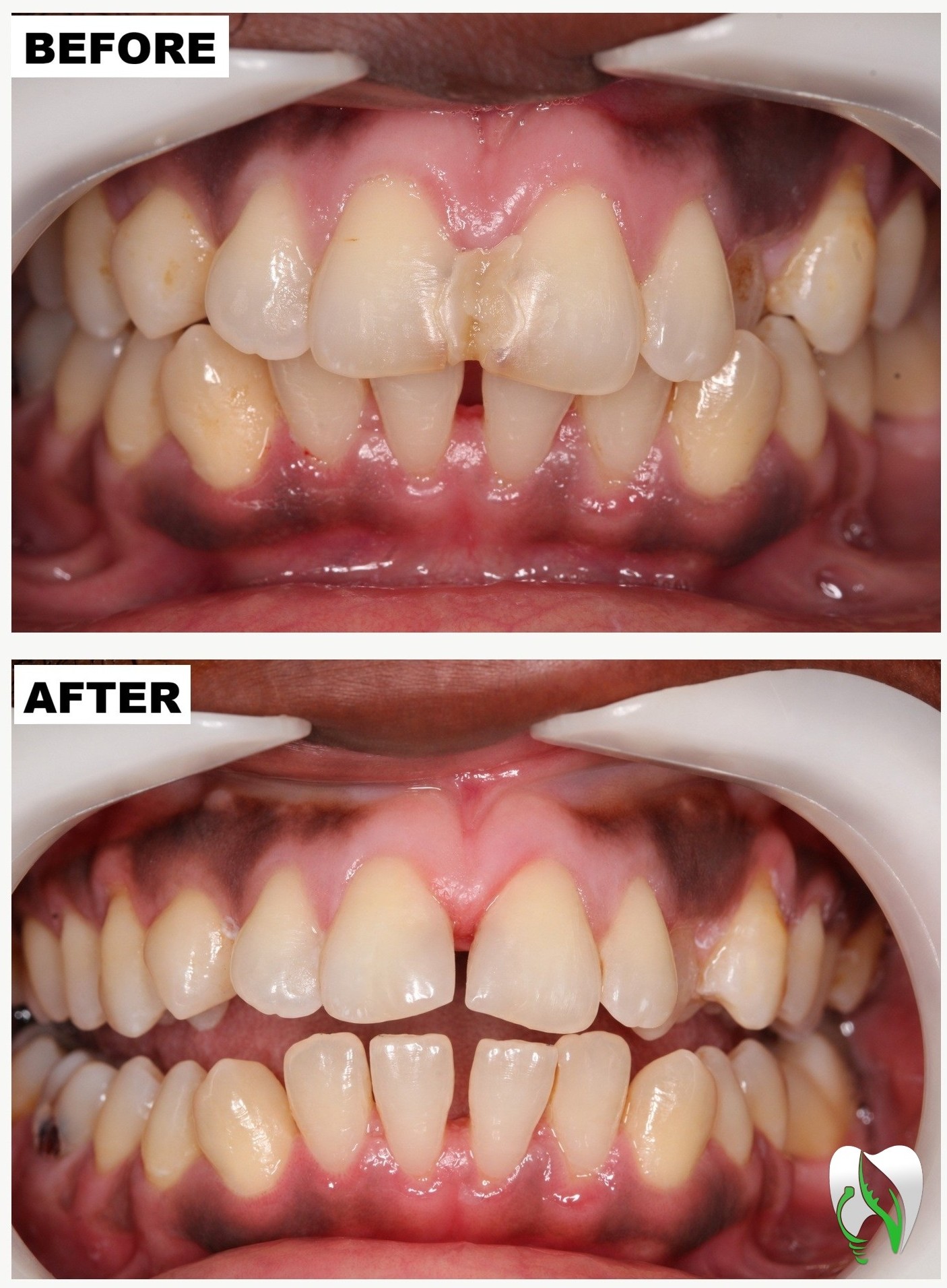حالة علاج كومبوزيت تجميلي مع احترام البنى التشريحية للسن