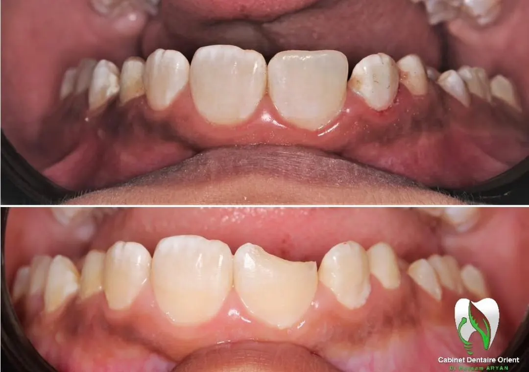تصحيح إطباق وتجميل أمامي