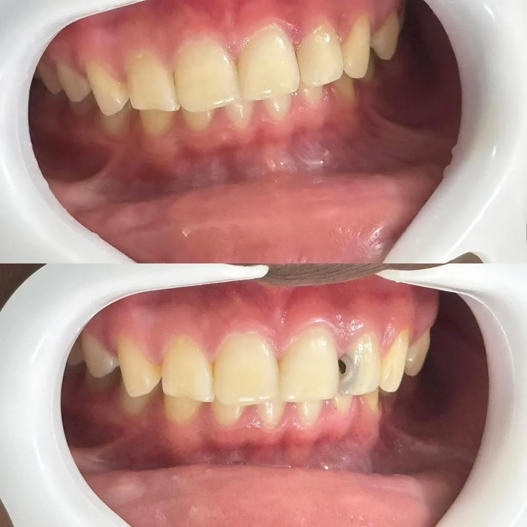 Aesthetic Restoration