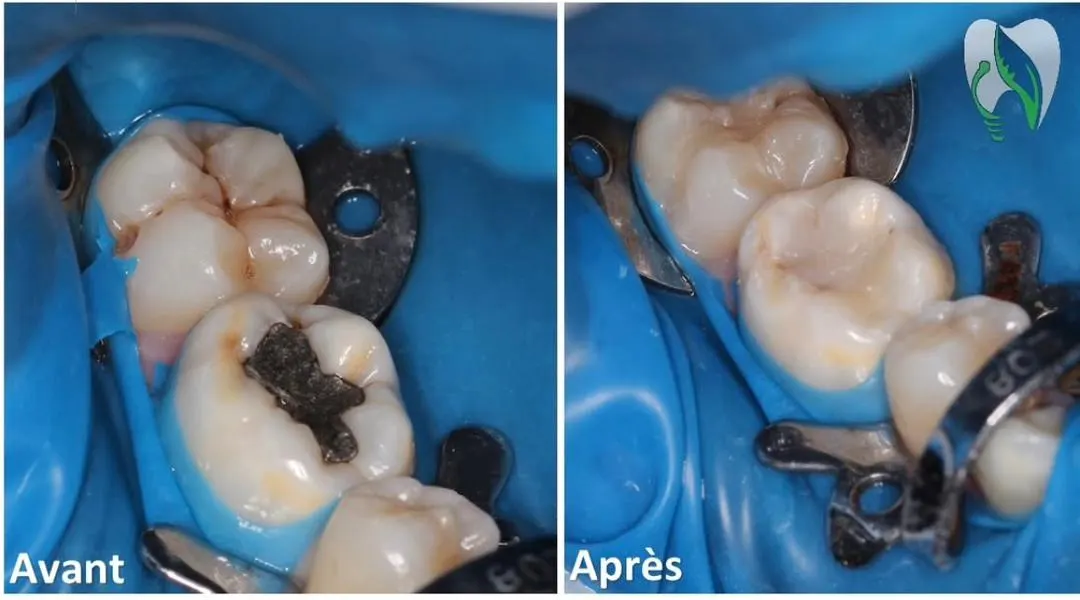 Posterior Filling